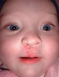 Clefts Cleft Lip Cleft Palate Birth