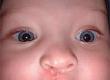 Cleft Lip or Palate